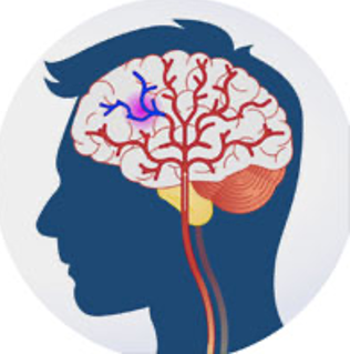 Stroke Rehabilitation